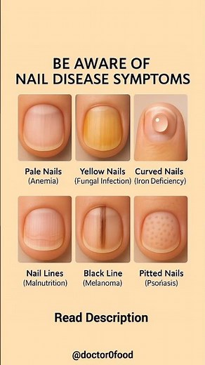 Nail Disease Warning Signs You Should Never Ignore | Nail Health Symptom Explained #healthylifestyle