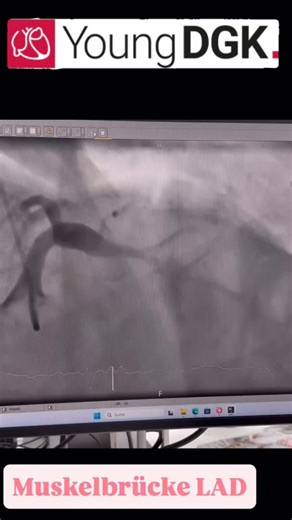 Young DGK on Instagram: "🎄 Young DGK Adventskalender Türchen 11 Muskelbrücke in der LAD Koronararterien verlaufen in der Regel epikardial. 🫀 Was wir hier sehen: 👉 Intramyokardial verlaufendes Segment der LAD - sogenannte Muskelbrücke 👉 Systolische Lumeneinengung („milking effect“) 👉 Diastolisch meist wieder normales Lumen 📍 Am häufigsten betroffen: LAD (v. a. mittleres Drittel) 📊 Prävalenz: je nach Methode bis ~5-20 % (Autopsie > CT > Angio) 🧠 Physiologie-Keypoint: Die koronare Perfusion