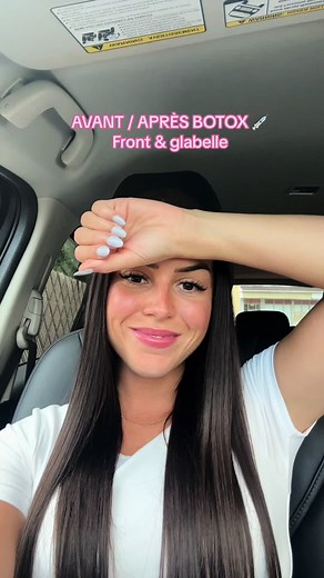Résultats du Botox : Mon avant et après