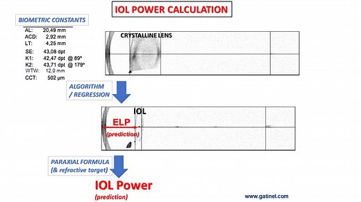 11. Effective Lens Position (ELP) : definition, back-calculation - Docteur Damien Gatinel