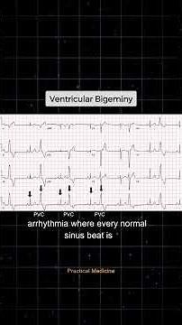 [OSCE: ECG Interpretation] What is the ECG diagnosis here?