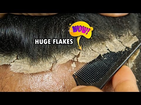 Dry Huge Flakes Removal From Dandruff Scalp #741
