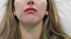 A Demonstration of Lip Filler Injections With Juvederm Ultra