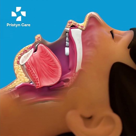 What is Tonsillitis | Best Tonsillectomy Surgery #shorts