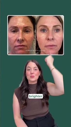 Pigment, who? 💁‍♀️ CoolPeel is amazing!