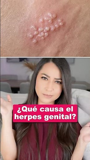¿Qué causa el herpes?👩🏻‍⚕️ #herpes #salud #medicina #datos #información