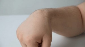 Ganglion Cyst Hygroma Wrist On Hand Stock Footage Video (100% Royalty-free) 3550366783 | Shutterstock