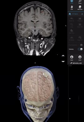 Neuralink on Instagram: "Neuralink’s mind-mapping technology takes implant placement to the next level with its multi-scanning superpower! 🧠✨ MRI and CT scans team up to create a detailed map of your skull, while fMRI scans pinpoint the perfect spot for our electrodes to park. This precision targeting means our implant can tap into your brain’s coolest features without causing any unwanted side effects. Neuralink is like the GPS for your brain, guiding us to the most epic destinations! #Neurali