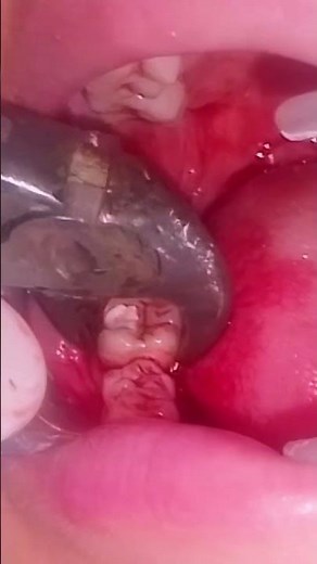 We Extracted a Molar With a DIY Tool
