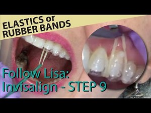 🦷 Follow Lisa: Invisalign 9 - Gap in tray and placement of elastic bands