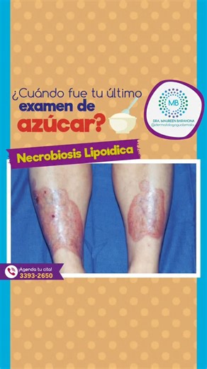 NECROBIOSIS LIPOIDICA . 🩺 Necrobiosis Lipoídica: una señal visible de niveles altos de glucosa . 🔹 ¿Cómo se ve en la piel? Aparecen placas rojizas o amarillentas, bien delimitadas, sobre todo en piernas (región pretibial). Con el tiempo, el centro se vuelve más delgado, brillante y de color amarillento, con vasos sanguíneos visibles. En algunos casos puede ulcerarse y doler. . 🔹 ¿Por qué se relaciona con la glucosa alta? Se debe a una alteración en la microcirculación y el colágeno de la piel