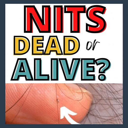 Dead vs Live Nits: Color of Lice Eggs - My Lice Advice
