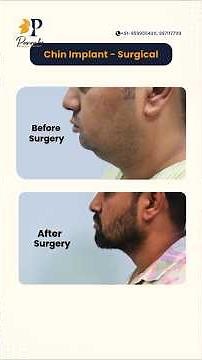 Chin Implant Before and After | Jawline Reshaping Surgery | Chin Implant & Liposuction