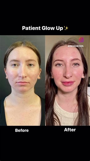 Glow up alert 📢📢📢 This gorgeus girl had a few different treatments and all we did was engance her natual beauty! 🤩🤩 📍Encore Medspa Walnut Creek or Pleasanton 📞 (925) 932-1843 📆 To book www.encoremdspa.com 📸 All videos have been posted with clients permission #encoremedspa #encoremedspawalnutcreek #encoremedspapleasanton #medspa #reels #medspareels #viral #dysport #botox #sculptra #bbl #ipl #lipfiller #antiaging #skincare #hydrafacial #trending #bayarea #injections #filler #bayareamedspa