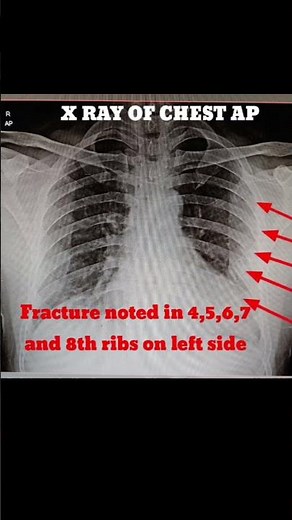 Chest x ray #fracture of ribs #radiology