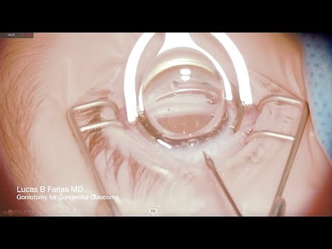 Goniotomy for Congenital Glaucoma