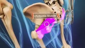 31K views · 393 reactions | Le syndrome du piriforme spine health...
