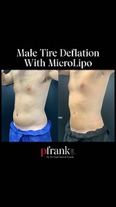 Here, I am performing tumescent microcannular liposuction (MicroLipo) on a male patient’s stomach and waist. Excess abdominal fat is stored in the tire area. Even with a proper diet and exercise, this is one of the most difficult areas to trim. MicroLipo is the gold standard for body sculpting, providing definitive, effective, and predictable results. This procedure only takes an hour and can be performed under local anesthesia, with a recovery time of 24 hours. Patients can expect to be on the