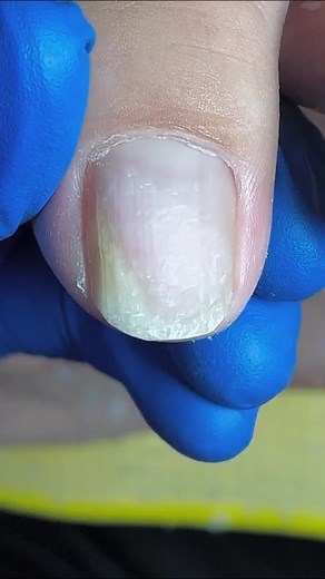 3.7K views · 12 reactions | #toenail #nail #ingrown | Ingrown Toenails | Facebook