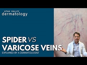What are those veins on your legs?? | Utah Valley Dermatology