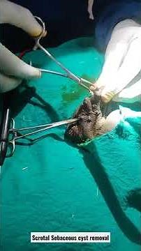 steatocystoma multiplex| scrotal sebaceous cyst removal