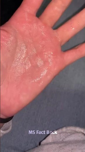 Problem of Sweating From Hands and Feet