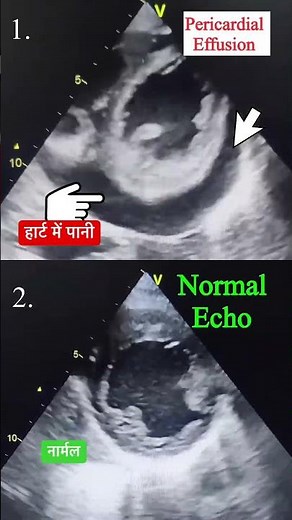 Pericardial effusion 🩸v/s Normal Echo #echo #effusion #shorts