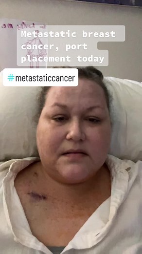 Understanding Metastatic Breast Cancer and Port Placement