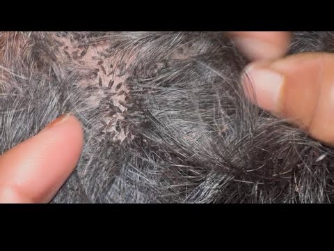 #nitsremoval🔥 Satisfying Lice Removal ASMR 😱 | Wife Deep Cleans Husband’s Hair | Nits Removal EP206