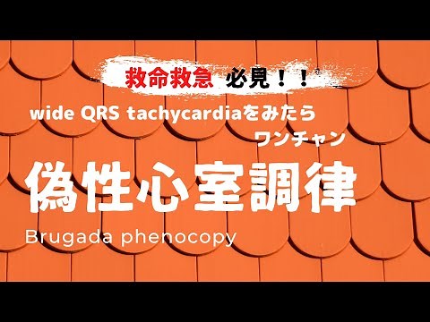【心電図】 偽性心室調律 Brugada phenocopy