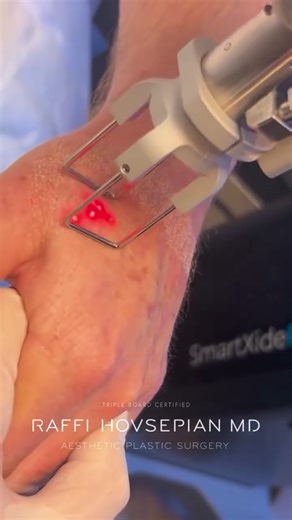 Hand Rejuvenation with Advanced Laser Technology
