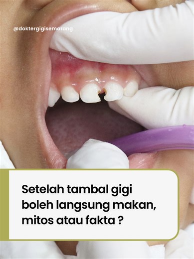 Setelah tambal gigi, sebaiknya berikan jeda 2-3 jam sebelum makan. Karena tambalan butuh waktu untuk mengeras dan menempel dengan sempurna. Kalau langsung makan, tambalan bisa cepat rusak, lepas atau tidak nyaman saat mengunyah. Tunggu sebentar, hasilnya bisa tahan lebih lama. #doktergigisemarang #tambalgigi