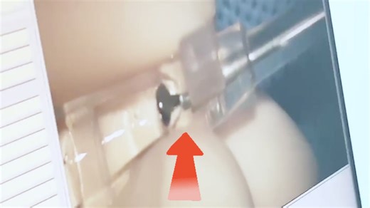 EVO+ ICL (V5) 手术vlog，跟我进手术室！