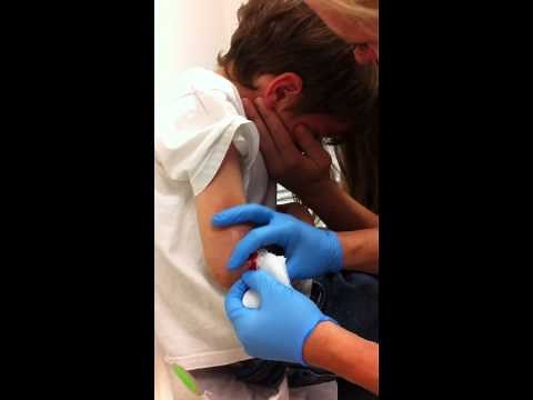 Cairo Cast and Pin Removal.MOV