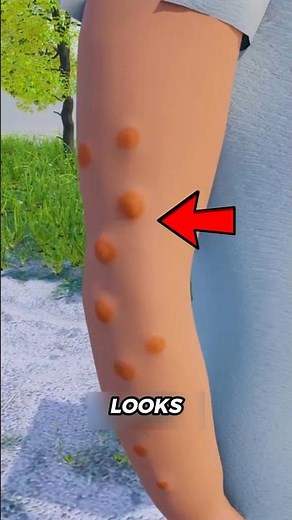 These Bites on Your Skin Might Be Bed Bugs… Don’t Ignore This