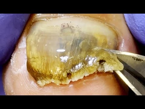 A Large Patch Of Gray Nails, Trimming Step By Step【Dr. Liu's Pedicur】