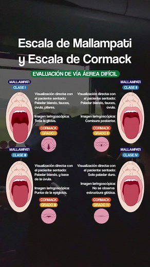 Escalas de Mallampati y Cormack para Vías Aéreas Difíciles