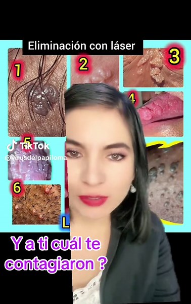 Eliminación de verrugas del VPH en Lima