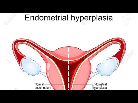 Endometrial Hyperplasia-All you need to know