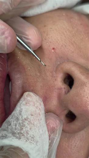 ✨ SATISFAÇÃO EM CADA DETALHE ✨ Extração de cravos ao redor dos lábios feita com técnica, cuidado e aquele resultado que a gente AMA ver 😍💆🏻‍♀️ Olha essa limpeza profunda devolvendo a textura lisinha e saudável para a pele! Cada pontinho removido é um passo para uma boca com contorno mais limpo, uniforme e renovado. Se você também ama esses vídeos satisfatórios, já curte ❤️, comenta o que achou 👇 e me segue para mais conteúdos de limpeza de pele que dão aquela sensação de missão cumprida! 🔥✨