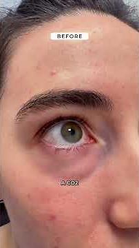 Lower blepharoplasty with fat repositioning fat grafting and co2laser