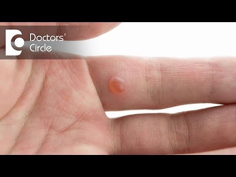 Possible causes of 'White hard bumps' on hands & fingers with its management - Dr. Rasya Dixit