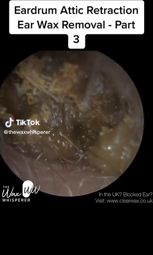 Understanding Ear Wax Impaction and Middle Ear Disorders