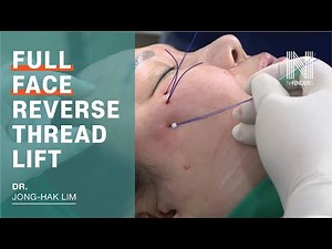 Full-face reverse thread lift | N-Fix & Royal & Scaffold