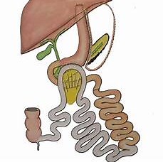 Bypass SASI -Bipartición Intestinal