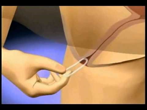 Método de Planificación Familiar: Anillo Vaginal