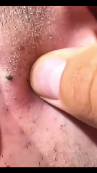 Effective Pimple Removal Techniques for Clear Skin