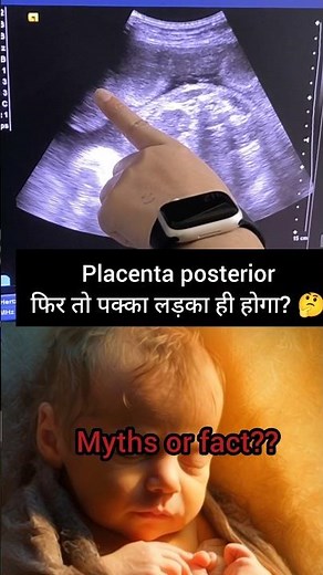 Posterior VS Anterior placenta#pregnancy#genderreveal#shorts