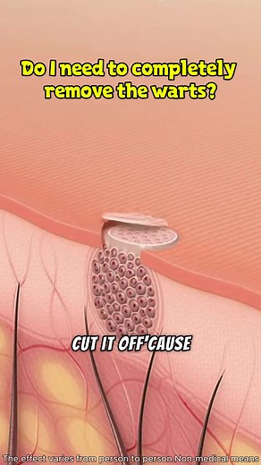 Effective Wart Remover for Skin Warts