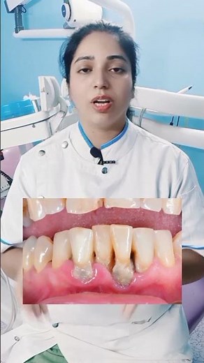 Pyorrhea #pyorrheatreatment #pyorrhea #dentalcare #dentaltips #viralshort #viraldentist #viral